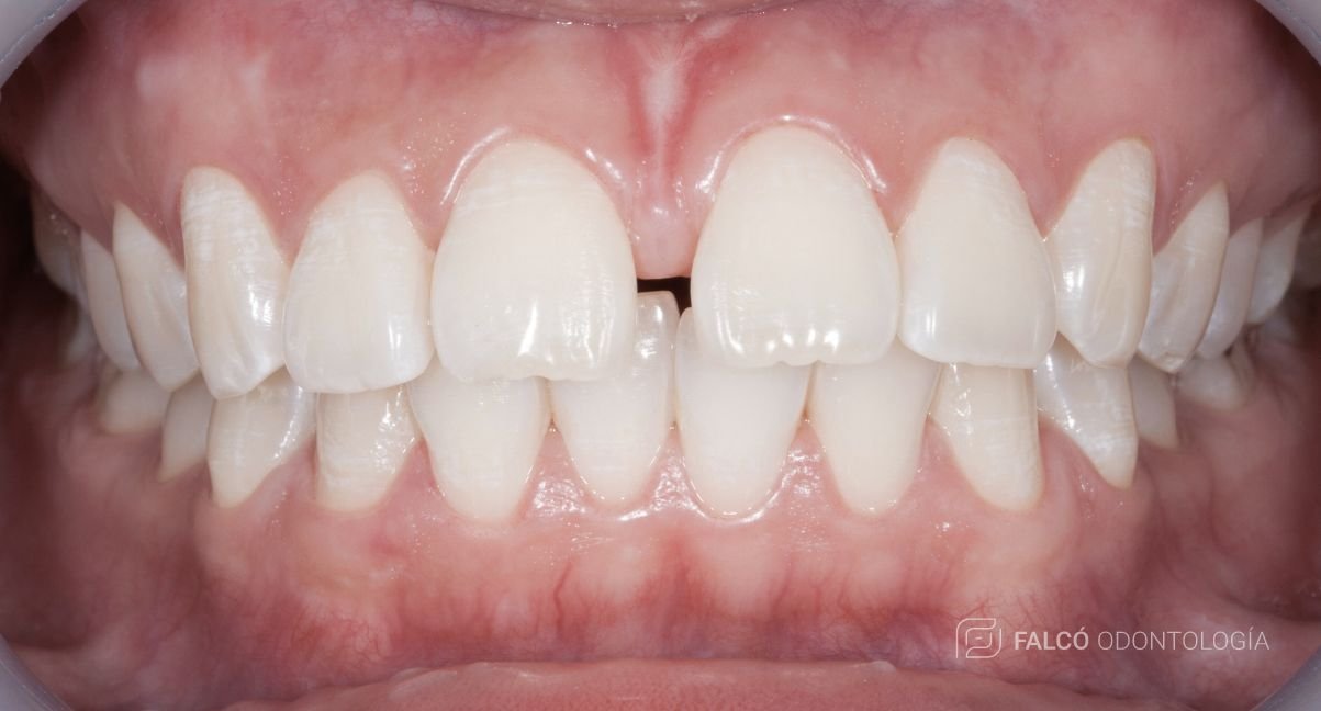 Carillas para cierre de diastemas - En Sarrià Sant Gervasi Barcelona