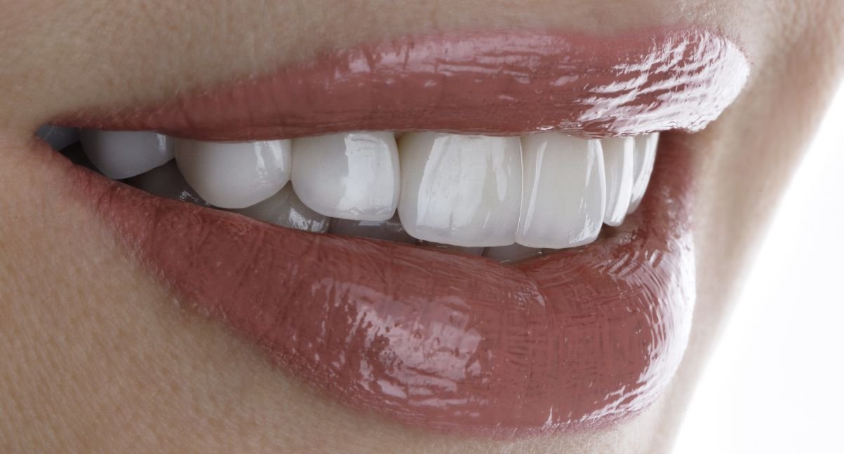 Carillas para manchas por tetraciclinas