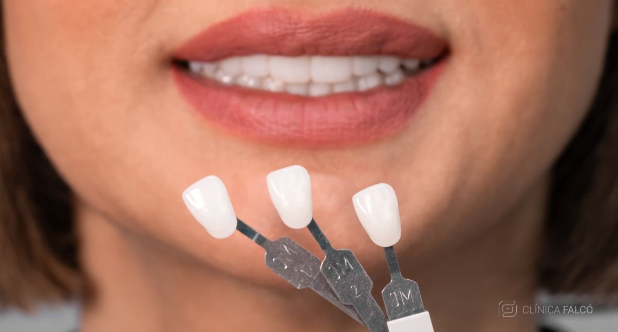 Carillas Dentales para Pacientes con Periodontitis
