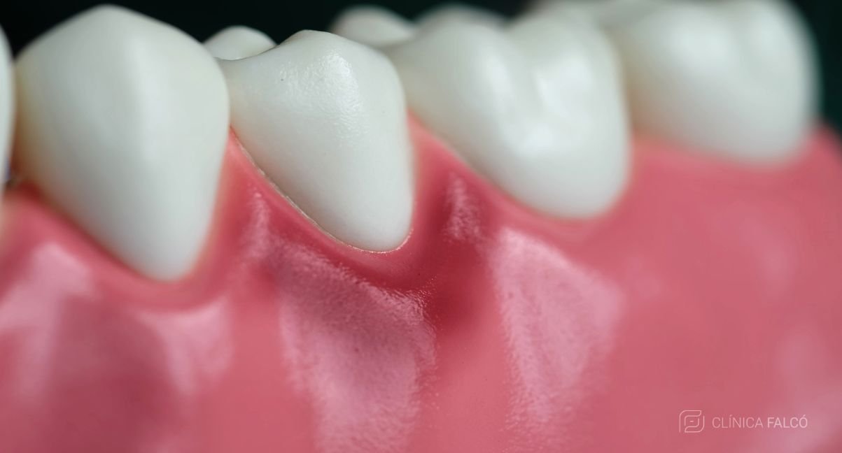 tratamiento gingivitis