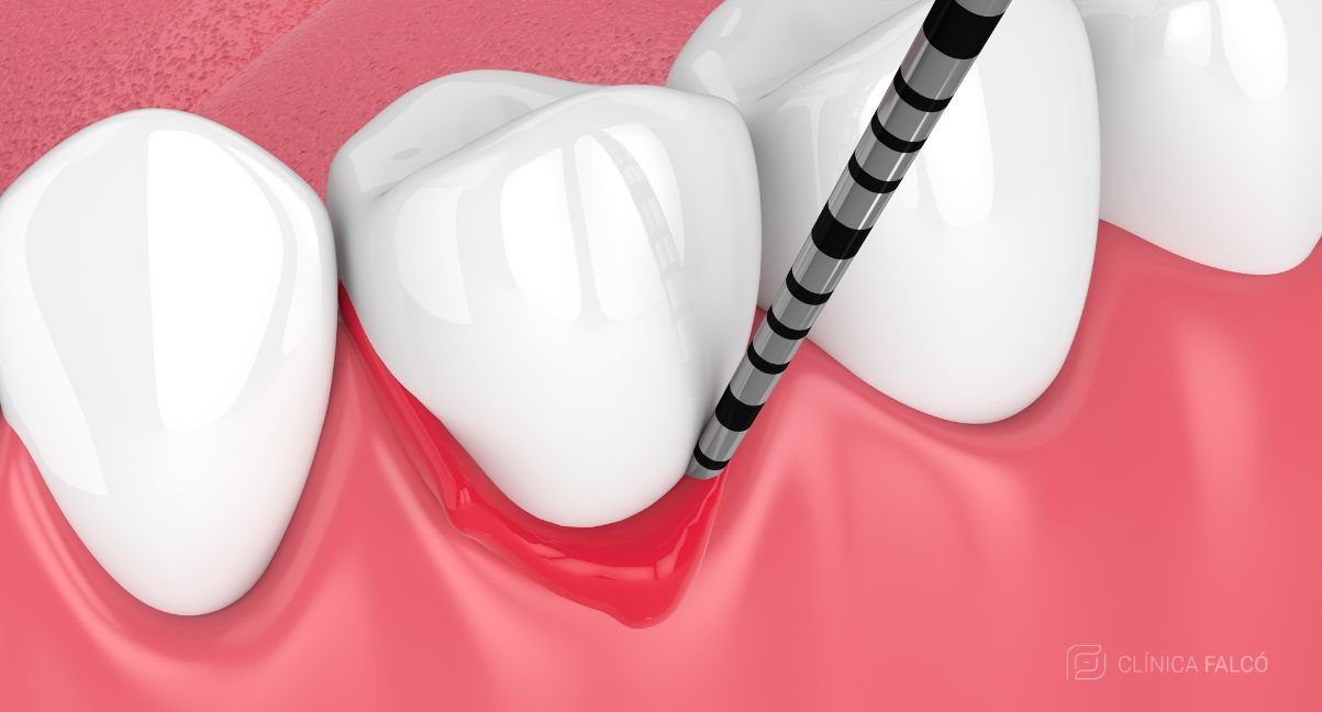 tratamiento periodontitis