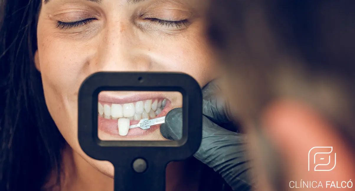 Carillas dentales y manchas por tetraciclinas