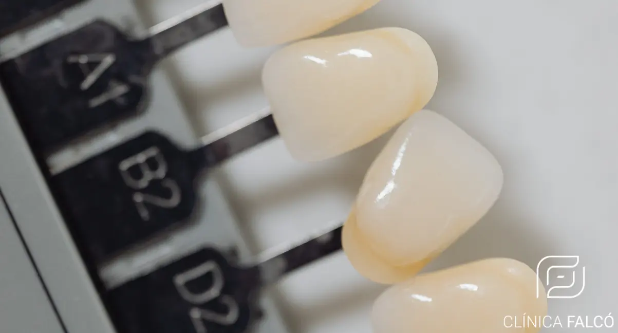 Carillas Dentales - FALCÓ